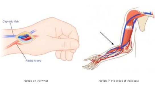 abords-pour-hemodialyse-fistules