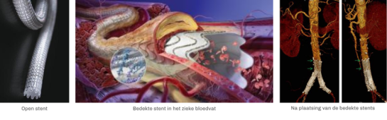 arteriele obliterante aandoeningen stent